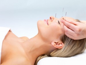 Acupuncture therapy of a young woman